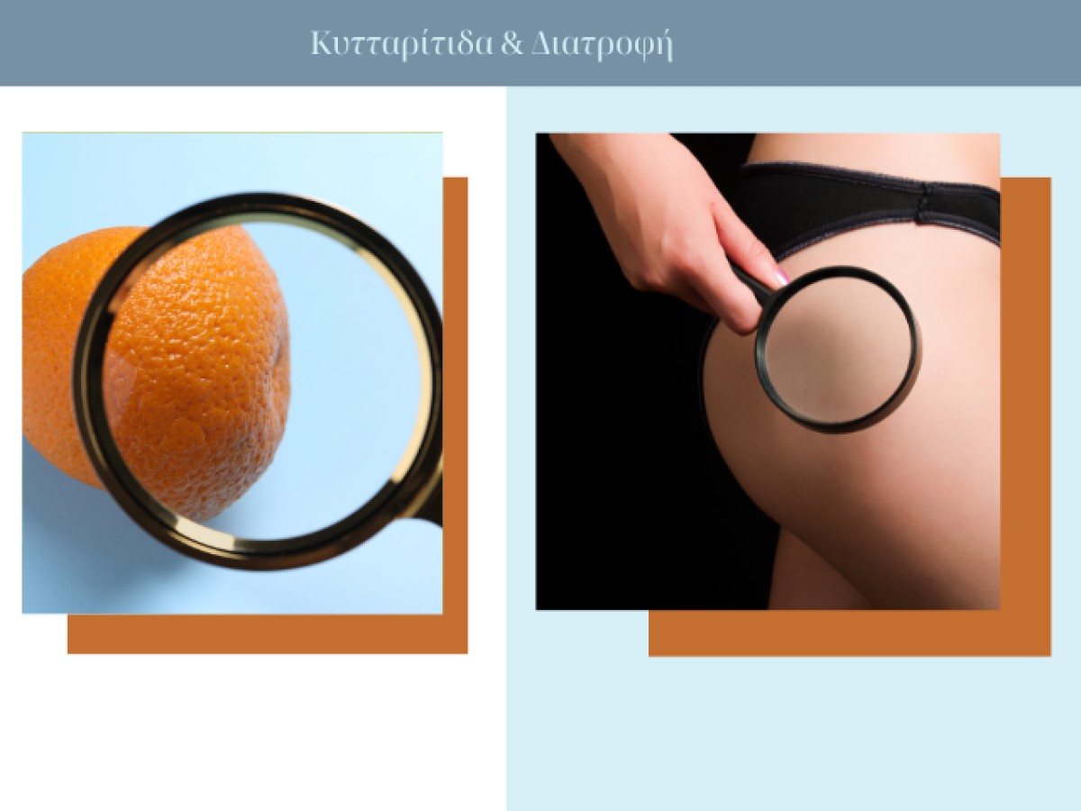 Κυτταρίτιδα και διατροφή