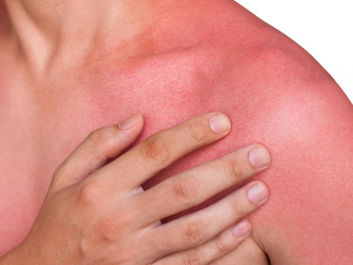 Εγκαύματα και πώς να τα αντιμετωπίσετε