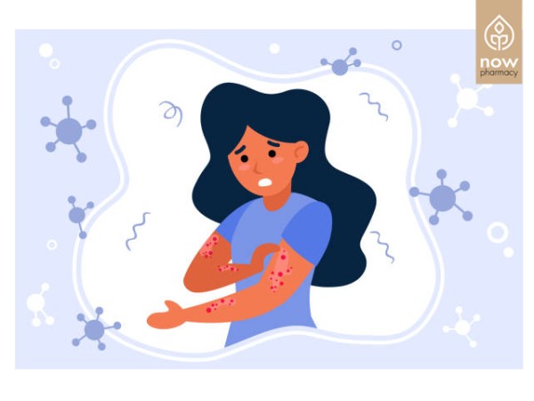 Τι είναι το έκζεμα και πώς αντιμετωπίζεται